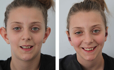 Young female Otoplasty patient before and after surgery 04, Dr Zurek