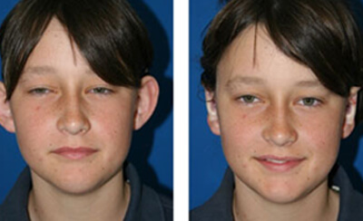 Otoplasty results, young male patient before and after ear pinning 08, Dr Zurek Sydney