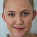 1 bf 1 - Landing Otoplasty Correction 35