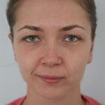 3 af - Landing Otoplasty Correction 41