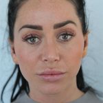 4 af - Landing Otoplasty Correction 47