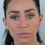 4 bf - Landing Otoplasty Correction 45