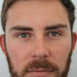 7 bf - Landing Otoplasty Correction 49