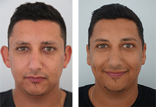 Male patient before and after ear pinning 02, non-incision Otoplasty with Dr Zurek