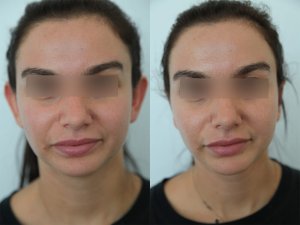otoplasty-ba-img1
