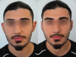 otoplasty-ba-img10
