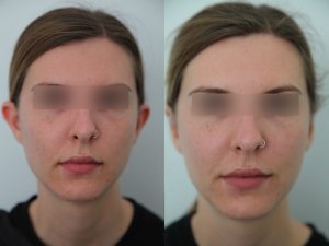 otoplasty-ba-img11