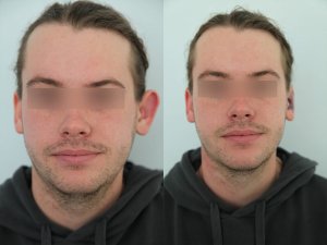 otoplasty-ba-img12