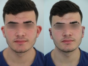 otoplasty-ba-img13