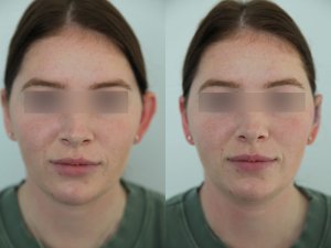 otoplasty-ba-img14