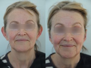 otoplasty-ba-img15