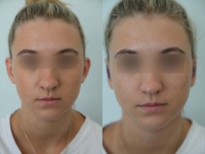 otoplasty-ba-img16