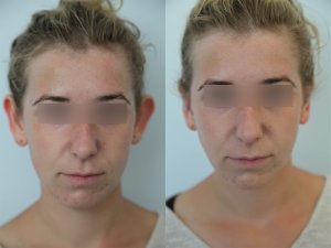 otoplasty-ba-img2
