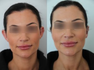 otoplasty-ba-img4