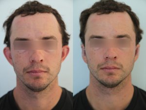 otoplasty-ba-img5