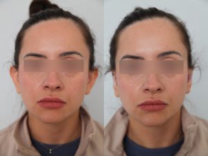 otoplasty-ba-img6