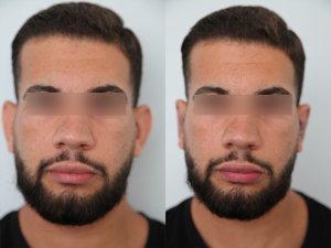otoplasty-ba-img7