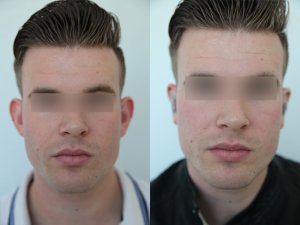 otoplasty-ba-img8