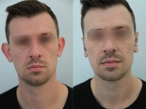 otoplasty-ba-img9